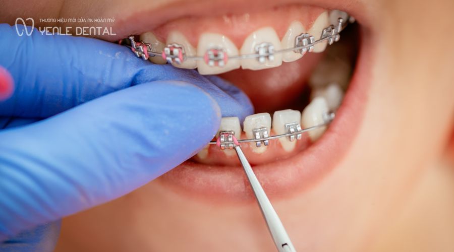 Niềng răng bị hóp má
